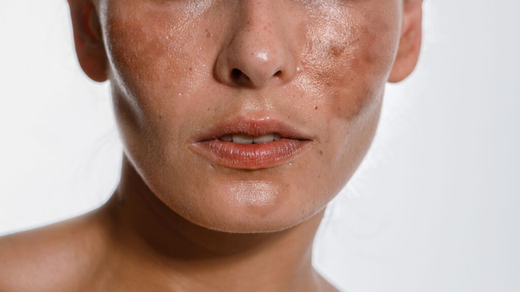 Le macchie della pelle sono il frutto del danno degenerativo cronico indotto dalle radiazioni UV.